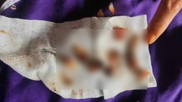 老李被口腔医院过度医疗,一次过拔光全口12颗牙齿。 老李被口腔医院过度医疗,一次过拔光全口12颗牙齿。