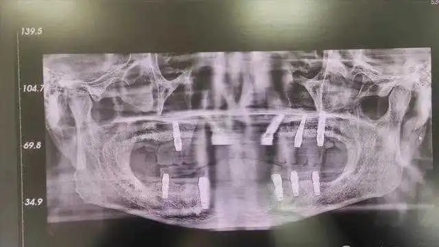 老李被口腔医院过度医疗,一次过拔光全口12颗牙齿。 老李被口腔医院过度医疗,一次过拔光全口12颗牙齿。