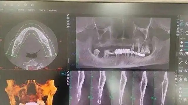 老李被口腔医院过度医疗,一次过拔光全口12颗牙齿。 老李被口腔医院过度医疗,一次过拔光全口12颗牙齿。