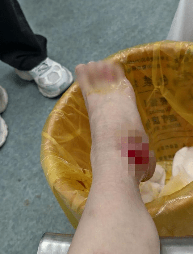 陈女士被诊断为二级烫伤,伤及右踝,一度需乘坐轮椅。网易新闻 陈女士被诊断为二级烫伤,伤及右踝,一度需乘坐轮椅。网易新闻