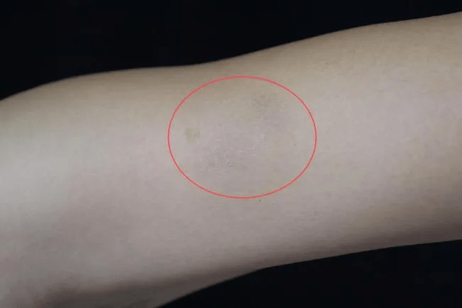 王女(化姓)发现左上臂出现花生大小的隆起,一年前后至鹌鹑蛋大小。 王女(化姓)发现左上臂出现花生大小的隆起,一年前后至鹌鹑蛋大小。